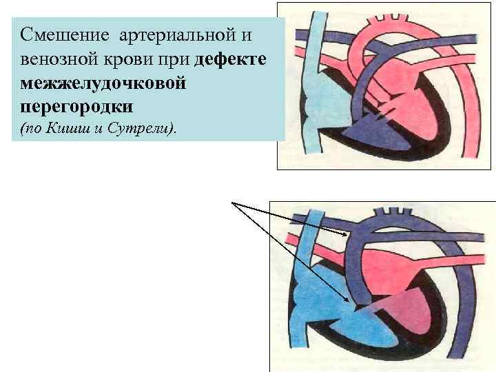 Cмешение артериальной и венозной крови при дефекте межжелудочковой перегородки (по Кишш и Сутрели). 