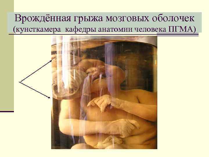 Врождённая грыжа мозговых оболочек (кунсткамера кафедры анатомии человека ПГМА) 