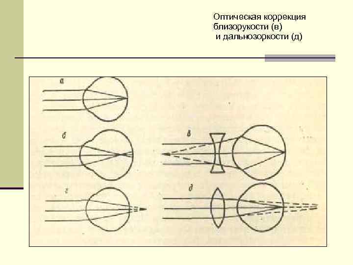 Рисунок близорукости и дальнозоркости