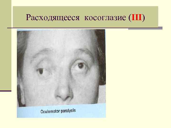 Расходящееся косоглазие (III) 