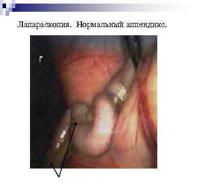 Лапараскопия. Нормальный аппендикс. 