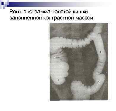 Рентгенограмма толстой кишки, заполненной контрастной массой. 