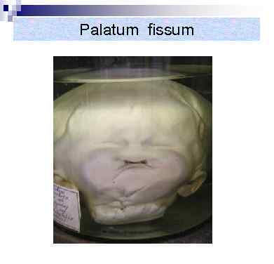 Palatum fissum 