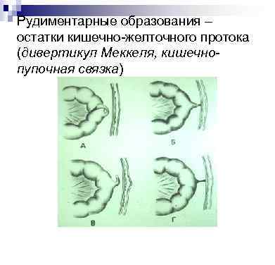 Рудиментарные образования – остатки кишечно-желточного протока (дивертикул Меккеля, кишечнопупочная связка) 