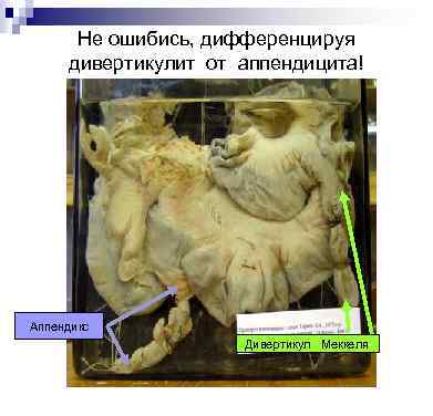 Не ошибись, дифференцируя дивертикулит от аппендицита! Аппендикс Дивертикул Меккеля 