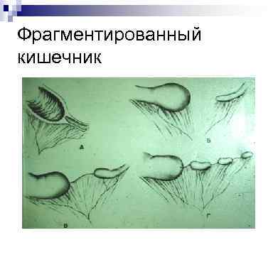 Фрагментированный кишечник 