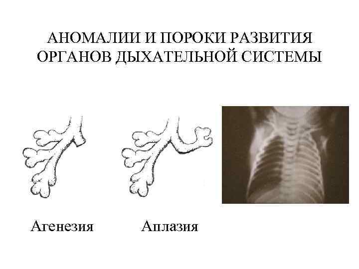 Пороки развития легких презентация