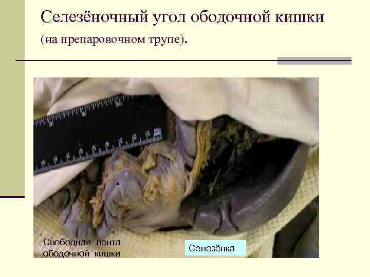 Селезёночный угол ободочной кишки (на препаровочном трупе). Свободная лента ободочной кишки Селезёнка 