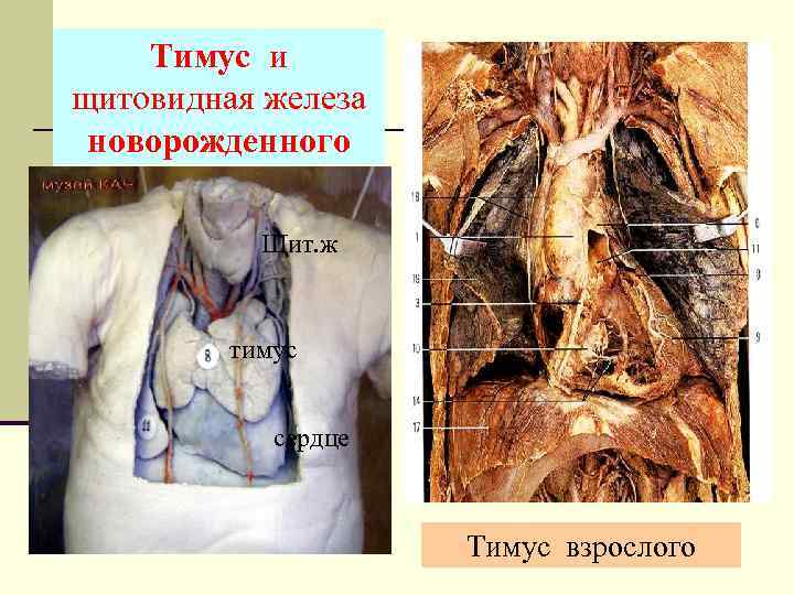 Тимус и щитовидная железа новорожденного Щит. ж тимус сердце Тимус взрослого 