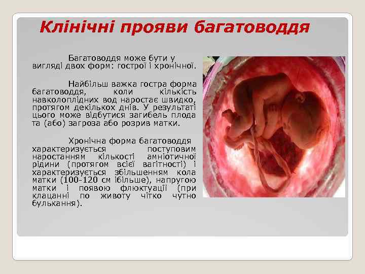 Клінічні прояви багатоводдя Багатоводдя може бути у вигляді двох форм: гострої і хронічної. Найбільш