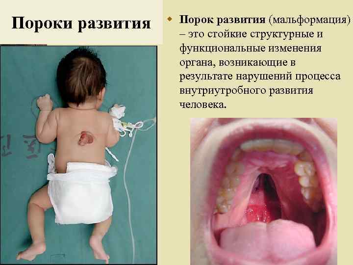 Пороки развития w Порок развития (мальформация) – это стойкие структурные и функциональные изменения органа,