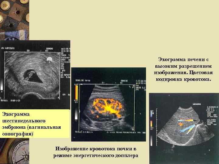 Эхограмма печени с высоким разрешением изображения. Цветовая кодировка кровотока. Эхограмма шестинедельного эмбриона (вагинальная сонография)