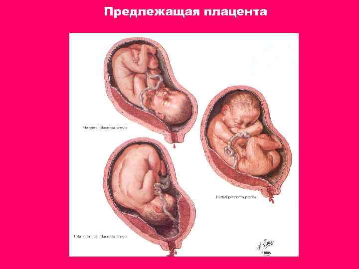 Предлежащая плацента 