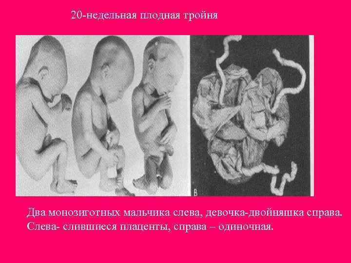 20 -недельная плодная тройня Два монозиготных мальчика слева, девочка-двойняшка справа. Слева- слившиеся плаценты, справа