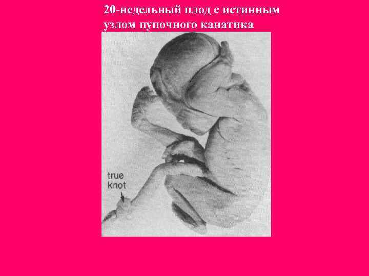 20 -недельный плод с истинным узлом пупочного канатика 