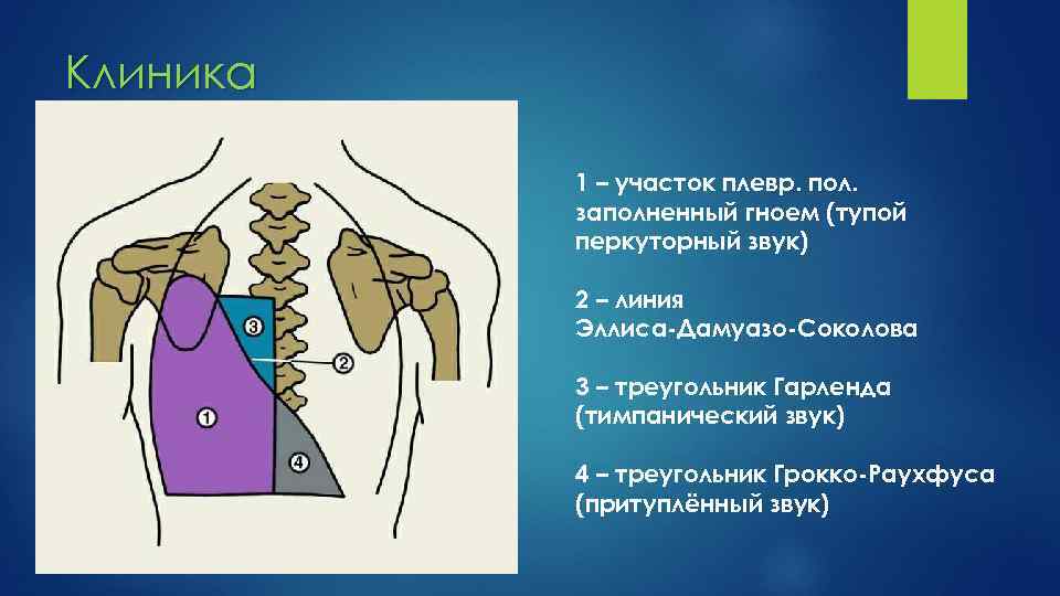 Перкуторная картина у больных с экссудативным плевритом