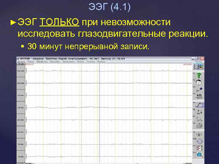 ЭЭГ (4. 1) ► ЭЭГ ТОЛЬКО при невозможности исследовать глазодвигательные реакции. § 30 минут