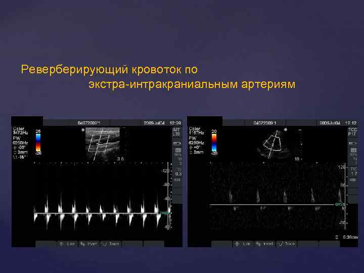 Реверберирующий кровоток по экстра-интракраниальным артериям 