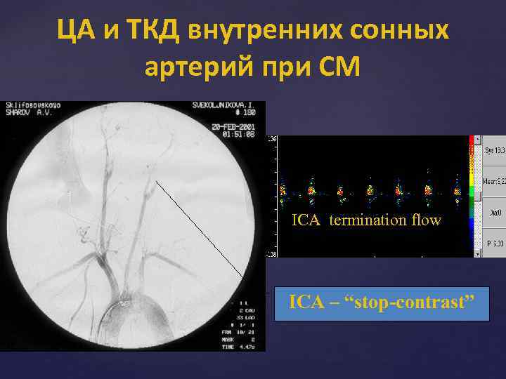 ЦА и ТКД внутренних сонных артерий при СМ ICA termination flow ICA – “stop-contrast”