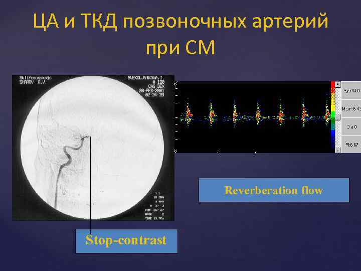 ЦА и ТКД позвоночных артерий при СМ Reverberation flow Stop-contrast 