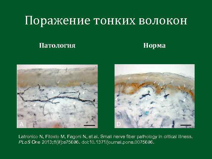 Поражение тонких волокон Патология Норма Latronico N, Filosto M, Fagoni N, et al. Small