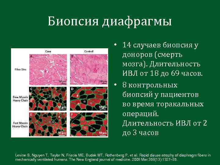 Биопсия диафрагмы • 14 случаев биопсия у доноров (смерть мозга). Длительность ИВЛ от 18