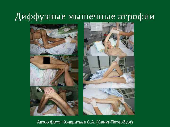 Диффузные мышечные атрофии Автор фото: Кондратьев С. А. (Санкт-Петербург) 