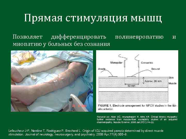 Прямая стимуляция мышц Позволяет дифференцировать полиневропатию миопатию у больных без сознания и Рисунок из:
