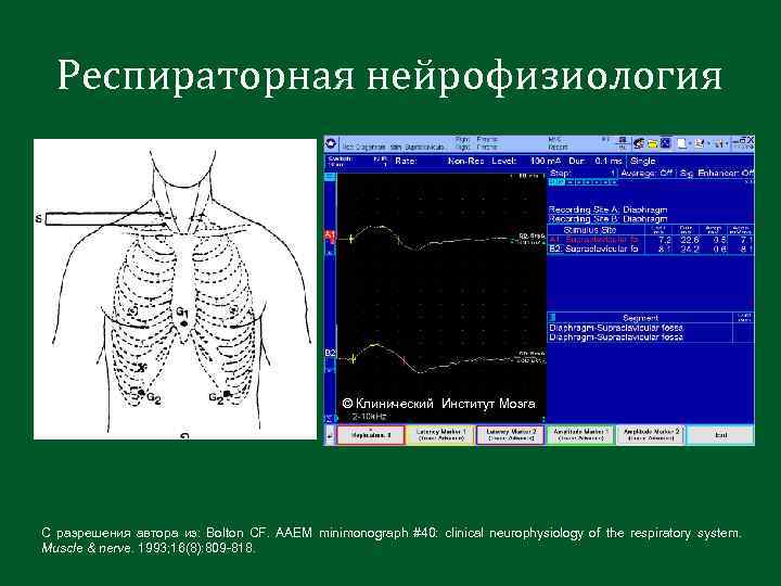 Респираторная нейрофизиология © Клинический Институт Мозга С разрешения автора из: Bolton CF. AAEM minimonograph