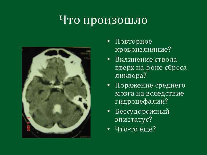 Что произошло • Повторное кровоизлияние? • Вклинение ствола вверх на фоне сброса ликвора? •