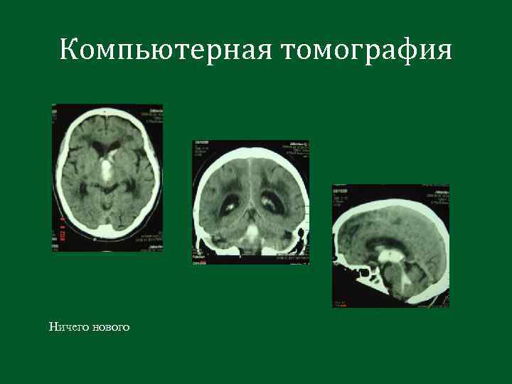 Компьютерная томография Ничего нового 