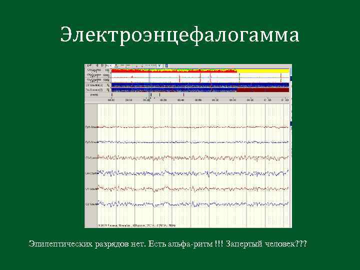 Электроэнцефалогамма Эпилептических разрядов нет. Есть альфа-ритм !!! Запертый человек? ? ? 
