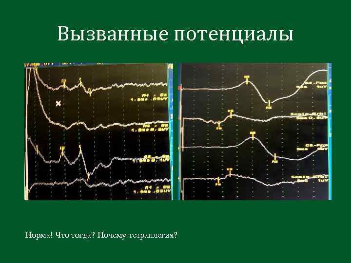 Вызванные потенциалы Норма! Что тогда? Почему тетраплегия? 