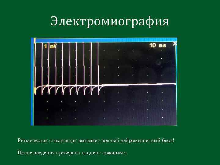 Электромиография Ритмическая стимуляция выявляет полный нейромышечный блок! После введения прозерина пациент «оживает» . 