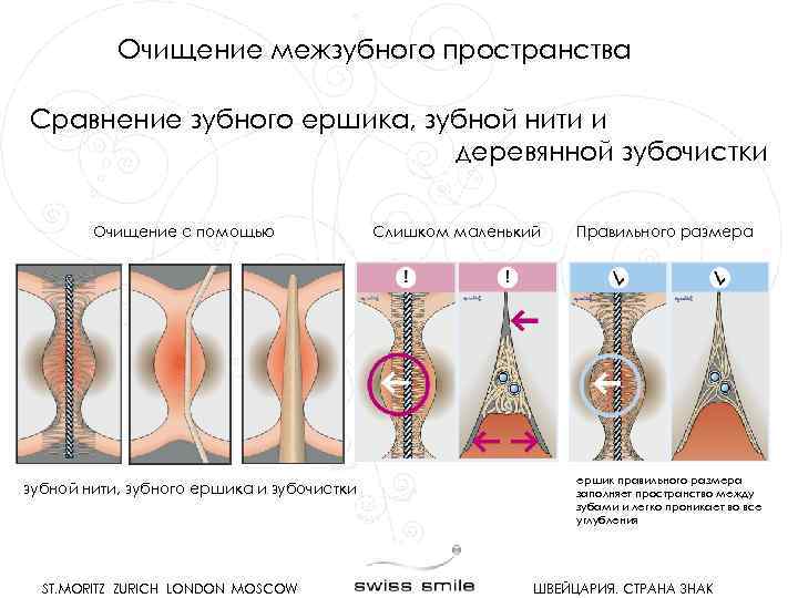 Очищение межзубного пространства Сравнение зубного ершика, зубной нити и деревянной зубочистки Очищение с помощью