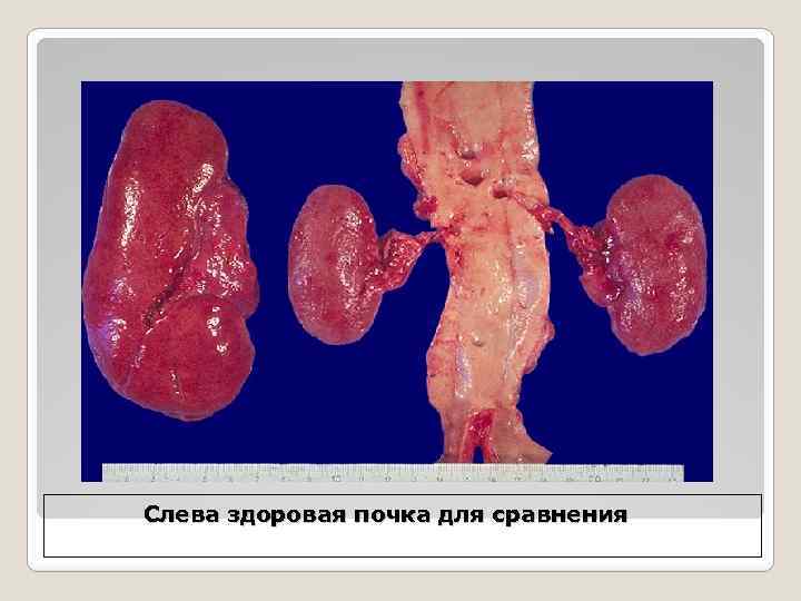 Слева здоровая почка для сравнения 