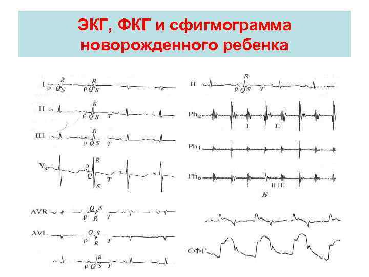 ЭКГ, ФКГ и сфигмограмма новорожденного ребенка 