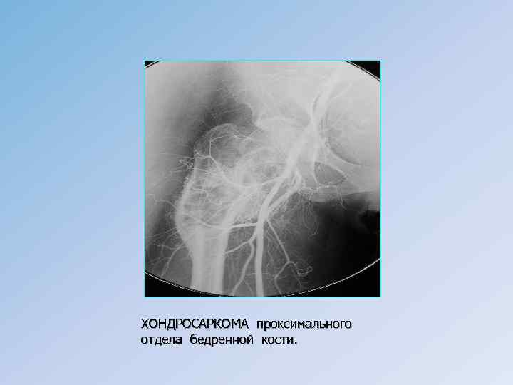 ХОНДРОСАРКОМА проксимального отдела бедренной кости. 