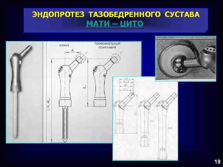 ЭНДОПРОТЕЗ ТАЗОБЕДРЕННОГО СУСТАВА МАТИ – ЦИТО 19 