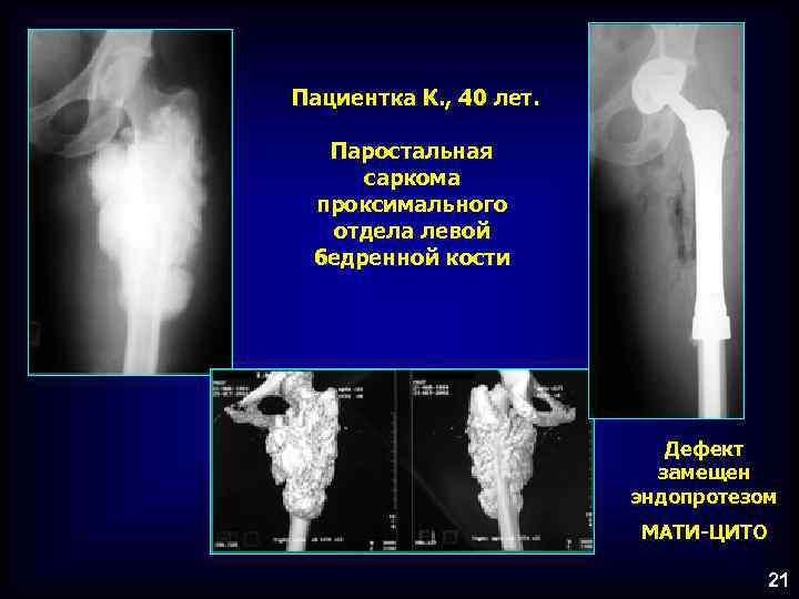 Пациентка К. , 40 лет. Паростальная саркома проксимального отдела левой бедренной кости Дефект замещен