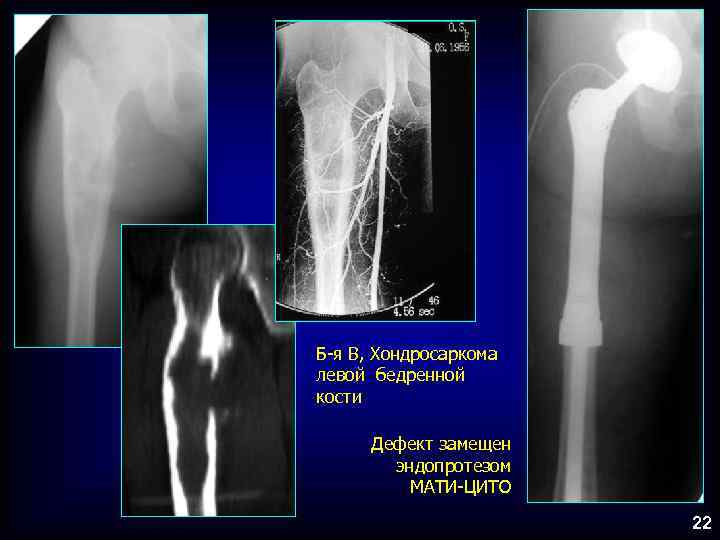 Б-я В, Хондросаркома левой бедренной кости Дефект замещен эндопротезом МАТИ-ЦИТО 22 