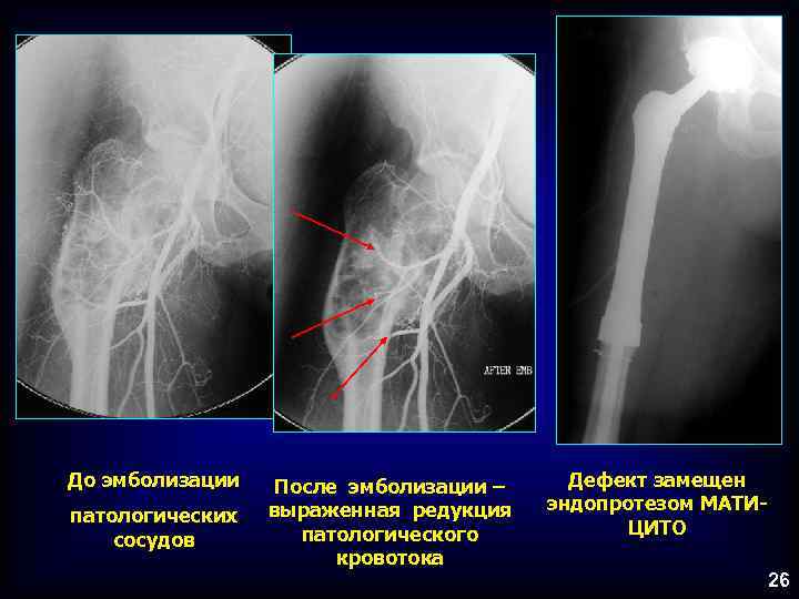 До эмболизации патологических сосудов После эмболизации – выраженная редукция патологического кровотока Дефект замещен эндопротезом