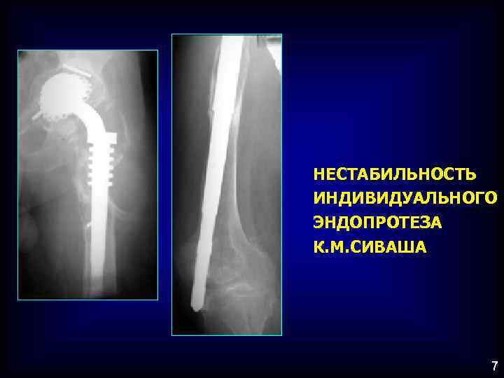 НЕСТАБИЛЬНОСТЬ ИНДИВИДУАЛЬНОГО ЭНДОПРОТЕЗА К. М. СИВАША 7 