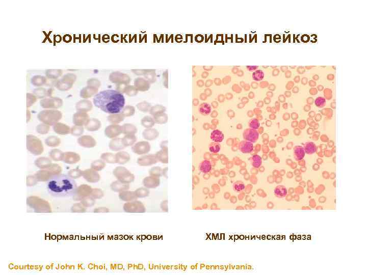 Картина крови при хроническом миелолейкозе