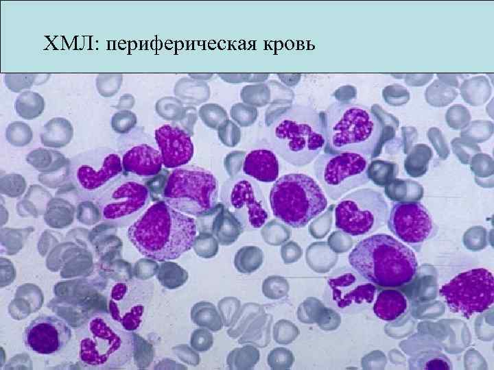 Хр миелолейкоз картина крови