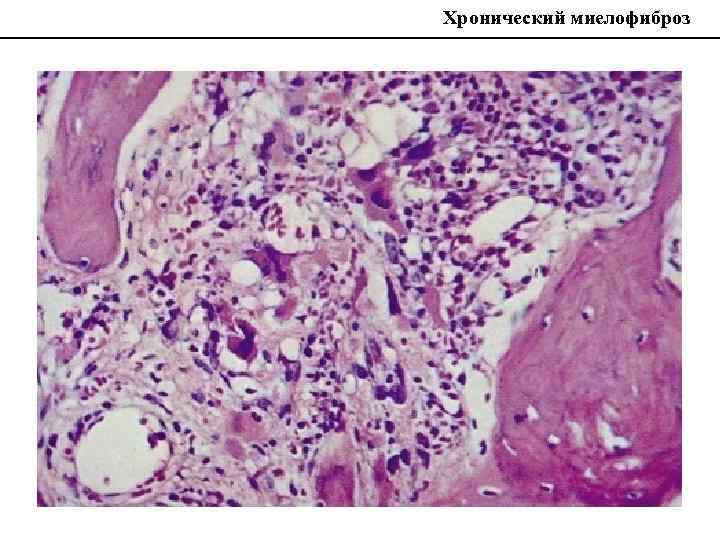 Идиопатический миелофиброз. Миелофиброз гистология. Первичный миелофиброз гистология. Миелофиброз костного мозга. Миелопролиферативная болезнь миелофиброз.