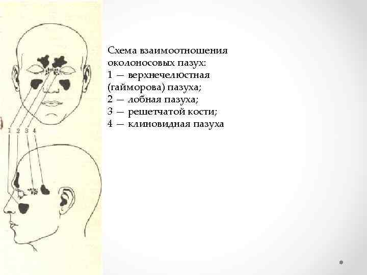Схема взаимоотношения околоносовых пазух: 1 — верхнечелюстная (гайморова) пазуха; 2 — лобная пазуха; 3