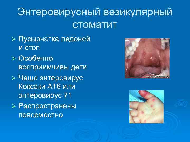 Энтеровирусный везикулярный стоматит Пузырчатка ладоней и стоп Ø Особенно восприимчивы дети Ø Чаще энтеровирус