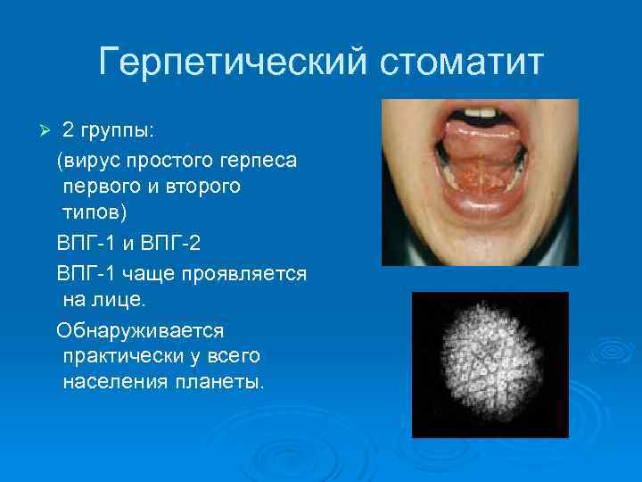 Герпетический стоматит Ø 2 группы: (вирус простого герпеса первого и второго типов) ВПГ-1 и
