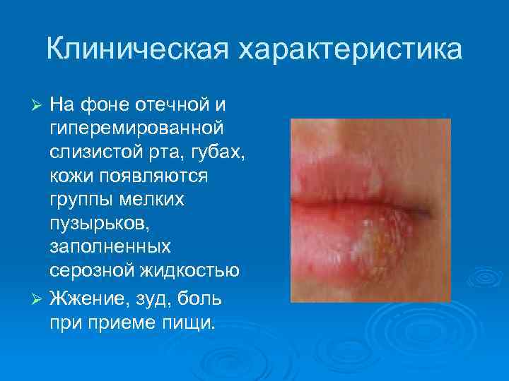 Клиническая характеристика На фоне отечной и гиперемированной слизистой рта, губах, кожи появляются группы мелких